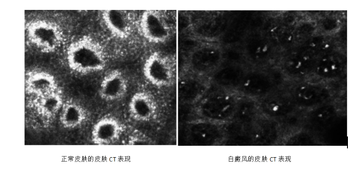 武汉环亚中医白癜风医院：白癜风有没有自愈的可能？？？