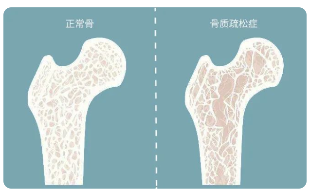 武汉刘三屋中医骨伤医院：警惕！大多数骨质疏松患者并不知道自己骨头脆