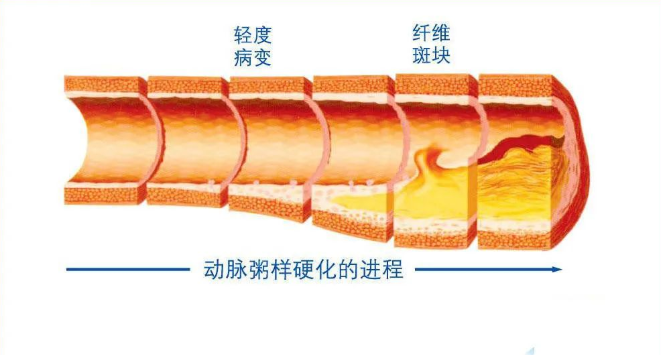 武汉汉方药谷中医院：用红子散调理冠心病