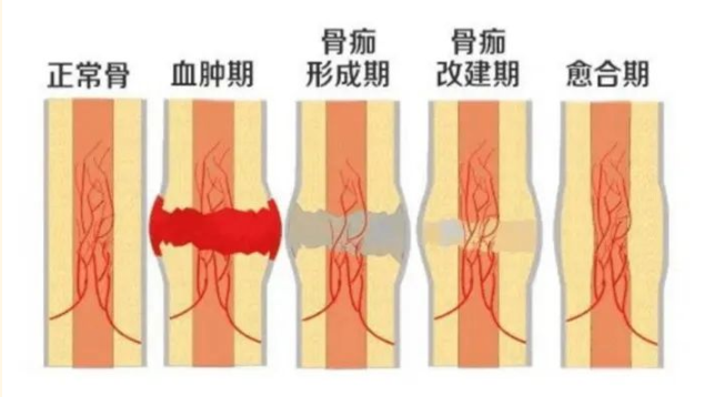 武汉梅竹青中医骨伤科诊所：帮助骨折愈合该吃些什么？