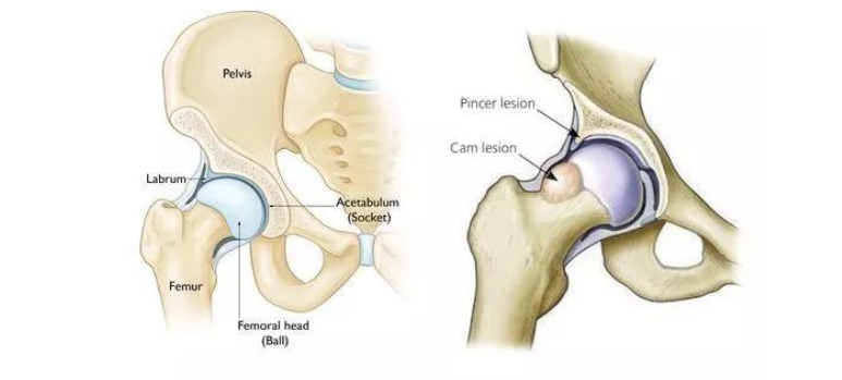 武汉首颐堂中医门诊部：髋关节撞击综合症，到底是什么？
