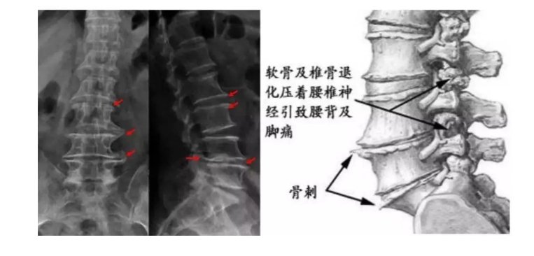 武汉首颐堂中医门诊部：关于骨刺，你需要知道的事