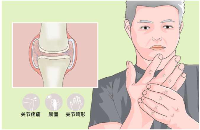 武汉健珍堂中医门诊部：神脊能量穴位埋线治疗类风湿性关节炎