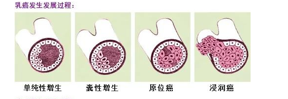 武汉健珍堂中医门诊部：神脊能量穴位埋线治疗乳腺增生（附医案）