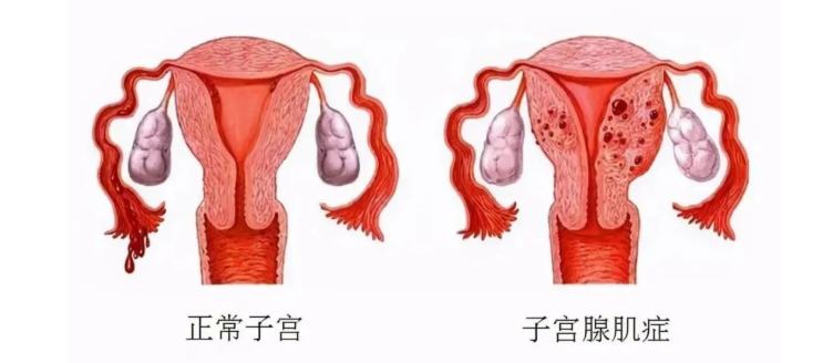 常州孟河医派名医堂：子宫腺肌症引发痛经?