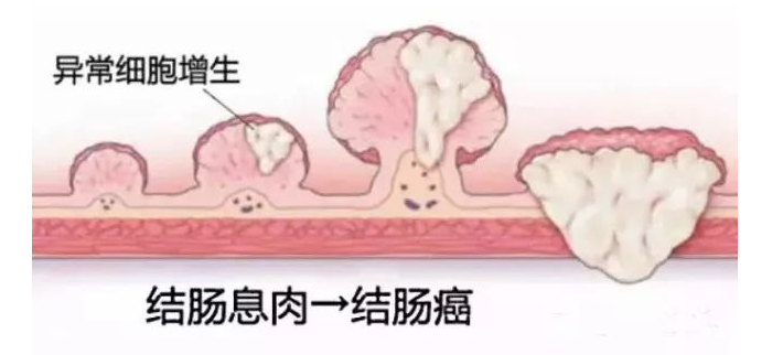 无锡医博中医肛肠医院：结肠镜，一项能救命的检查！ 40岁应该做，50岁必须做！