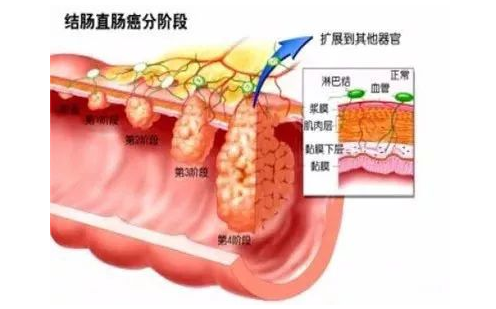 无锡医博中医肛肠医院：结肠镜，一项能救命的检查！ 40岁应该做，50岁必须做！