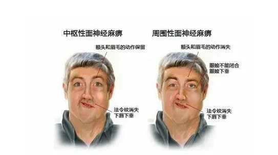 江阴百意中医医院：敷个面膜也能引发面瘫?