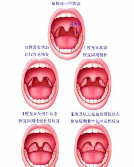 长沙千叶中医馆：扁桃体老是发炎怎么办？该不该切除？