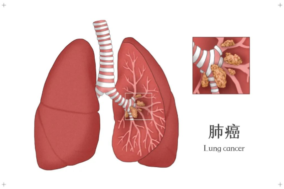 苏州市三春堂：什么是肿瘤？