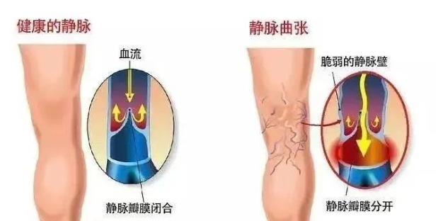 扬州岐兴堂中医馆：静脉曲张不用慌，祖传绝技来帮忙