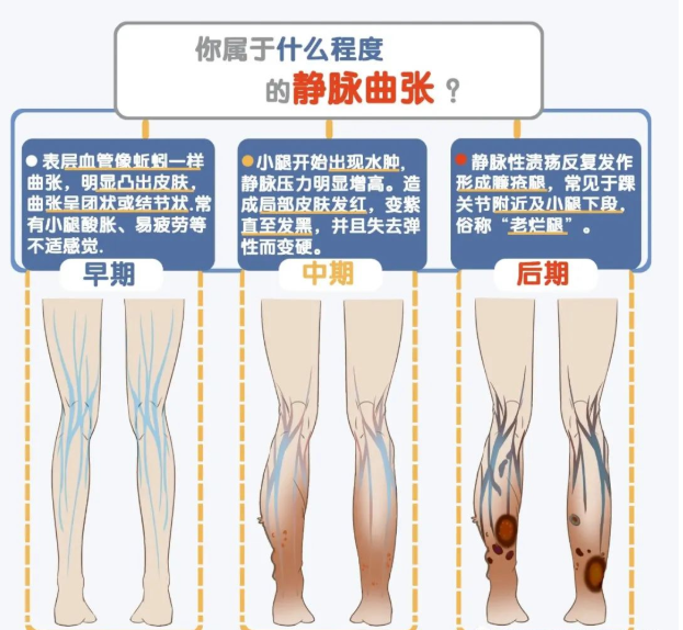 扬州岐兴堂中医馆：静脉曲张不用慌，祖传绝技来帮忙