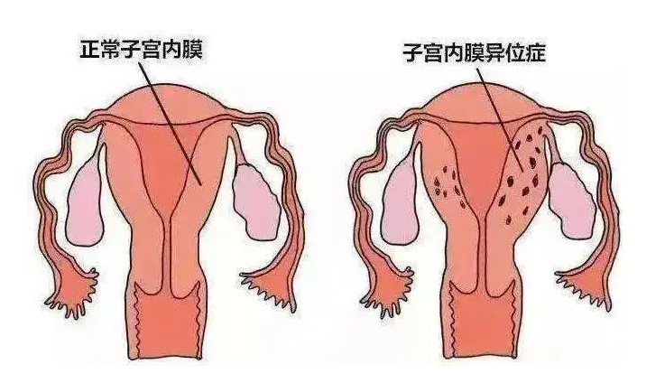 赣州宁都鸿康中医医院：这些妇科病不治疗将会导致不孕