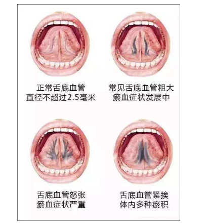 大连正源中医门诊部：舌下取栓