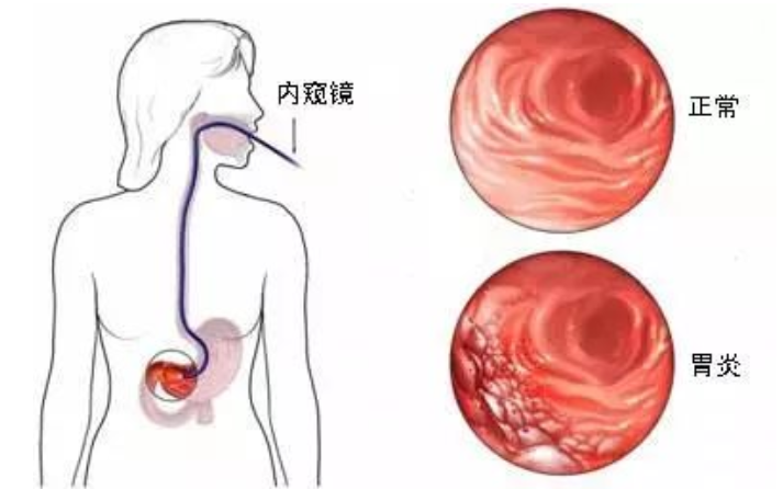 徐州丰益肛泰中医院:从浅表性胃炎到糜烂性或萎缩性胃炎，这三因素才是重点！