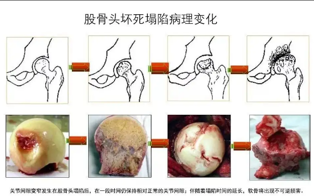 北京年轮中医骨科医院：切莫进入股骨头坏死的圈套