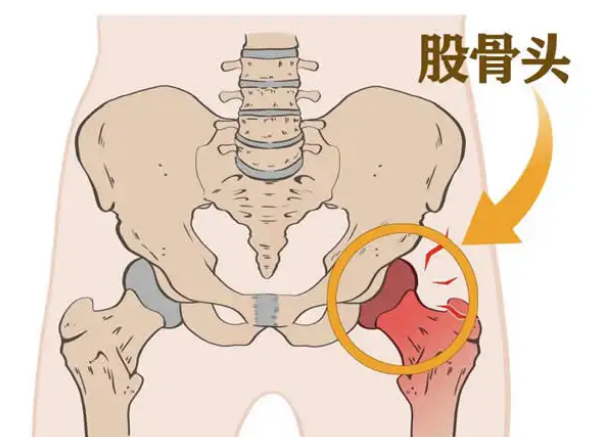 北京年轮中医骨科医院：切莫进入股骨头坏死的圈套