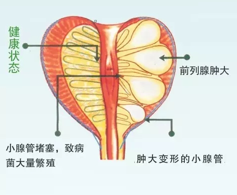 天津曹开镛中医医院：四君车前粥，专治前列腺增生