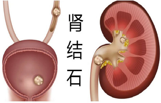 伤寒论经方学堂：一个强大的治结石妙方，胆肾结石都可排！