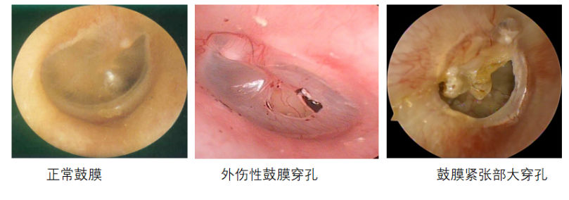 鼓膜穿孔危害多，修补鼓膜，很必要！