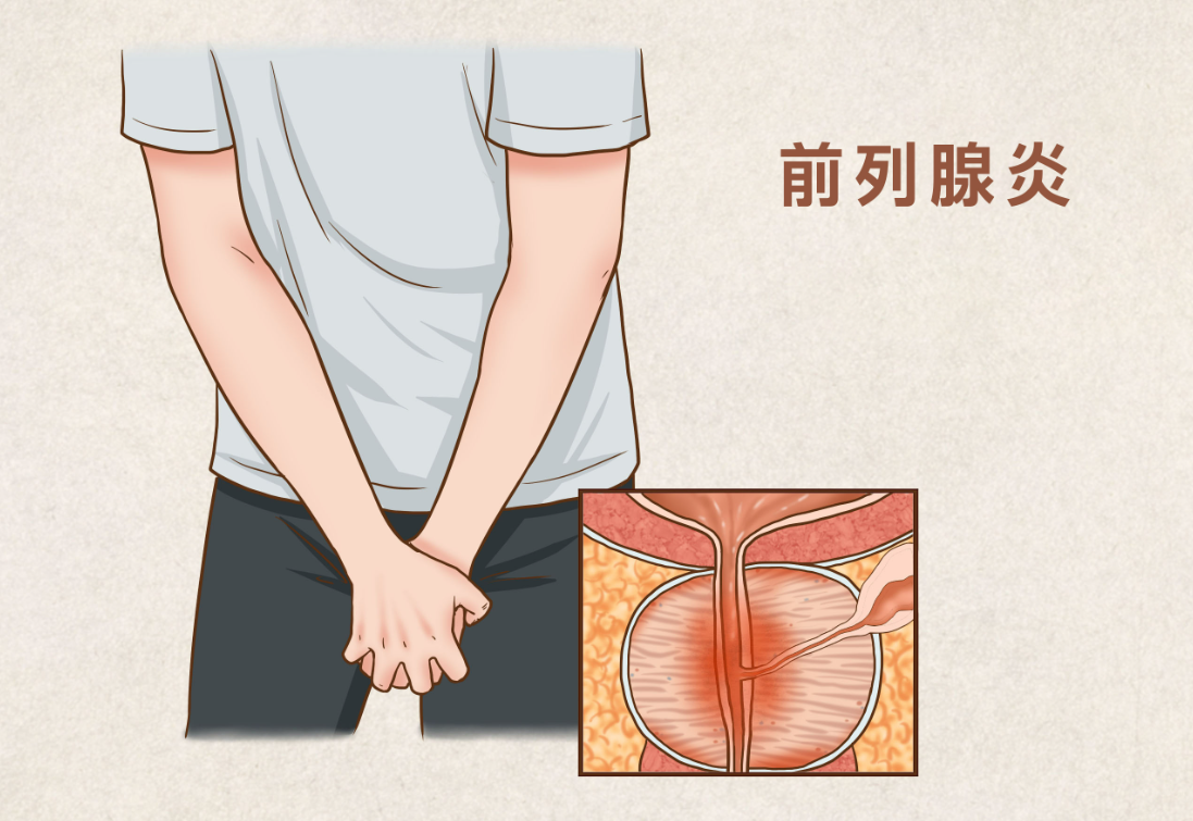 刘景源教授：2个古方搞定前列腺炎
