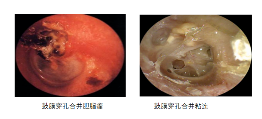 鼓膜穿孔危害多，修补鼓膜，很必要！