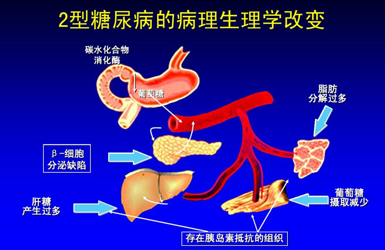 型糖尿病高发，中医药有效降血糖、延缓并发症"