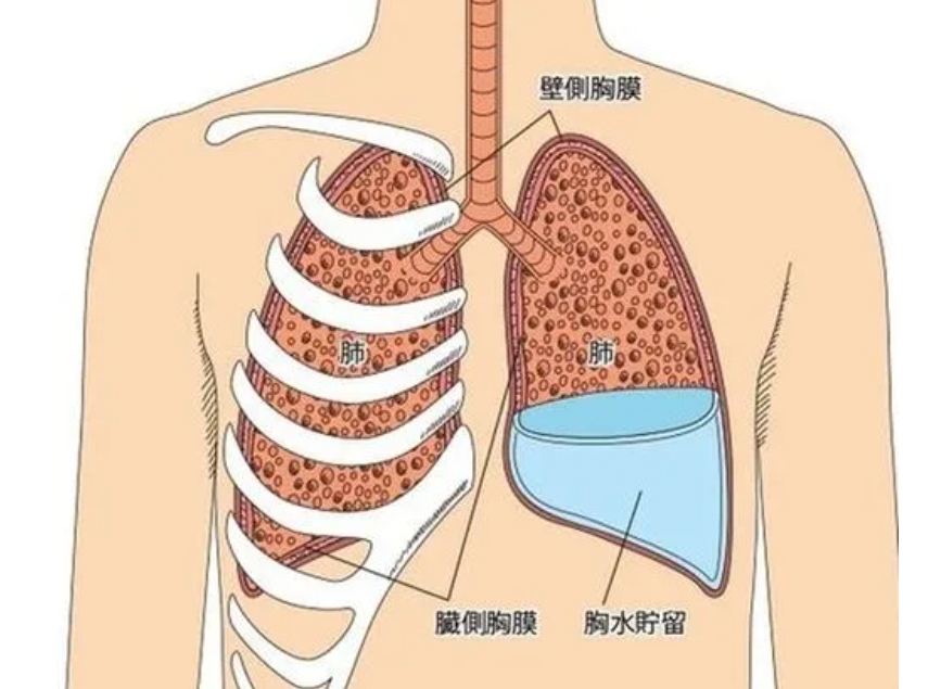 十枣汤治胸水、腹水，效果好！