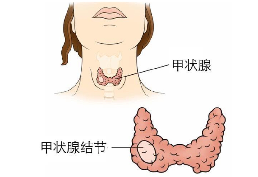 有甲状腺结节，要注意你的甲状腺结节属于哪一类？