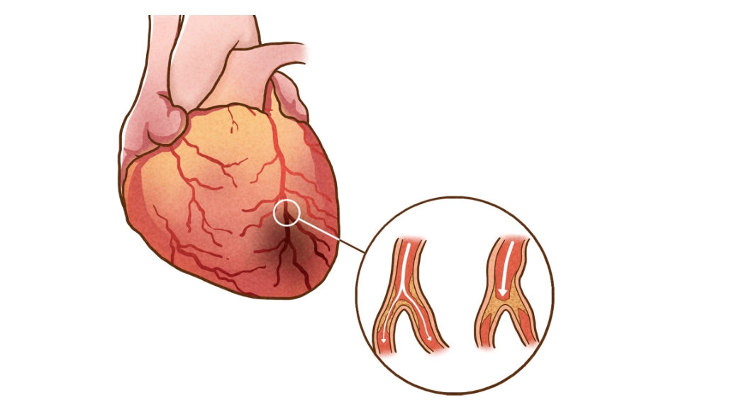 “致命杀手”冠心病，中医如何治疗呢？