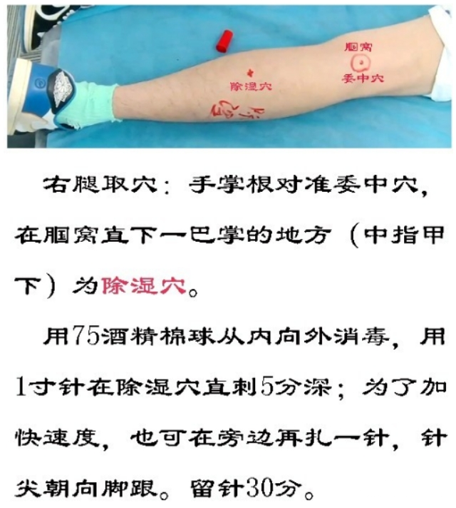 特效针法调理中风后遗症，快来看看~