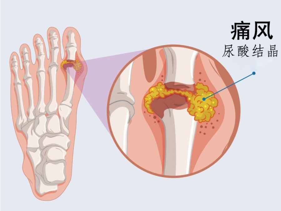 倪海厦：治痛风速度最快的经方，一两剂就好了