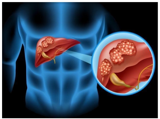 一旦眼睛发生这种改变，十有八九是肝癌，最好去检查一下