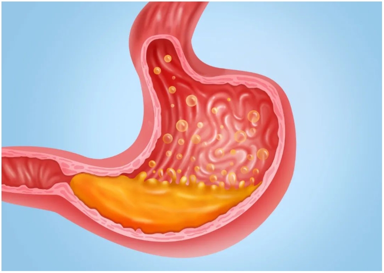 胃胀、胃痛、胃酸不是“小毛病”！警惕癌变的5个信号！