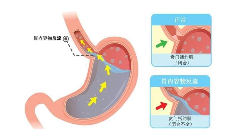 频繁反酸烧心，到底是哪里出了问题？