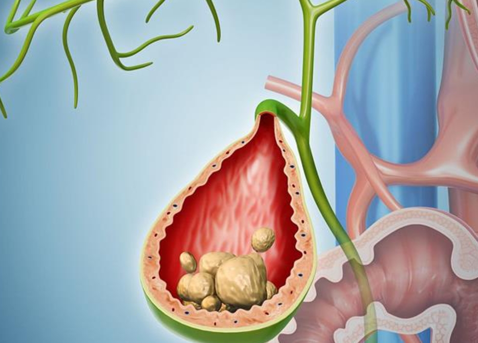 胆结石的中药调理方参考