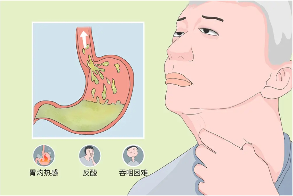 胃食管反流病的预防和日常保健！