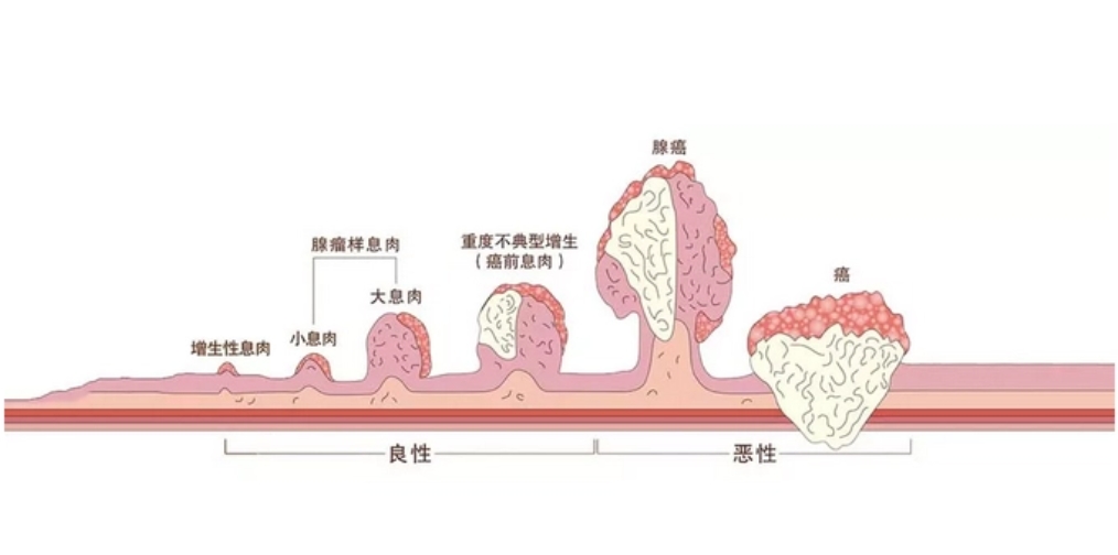 肠息肉究竟是什么样的病症？