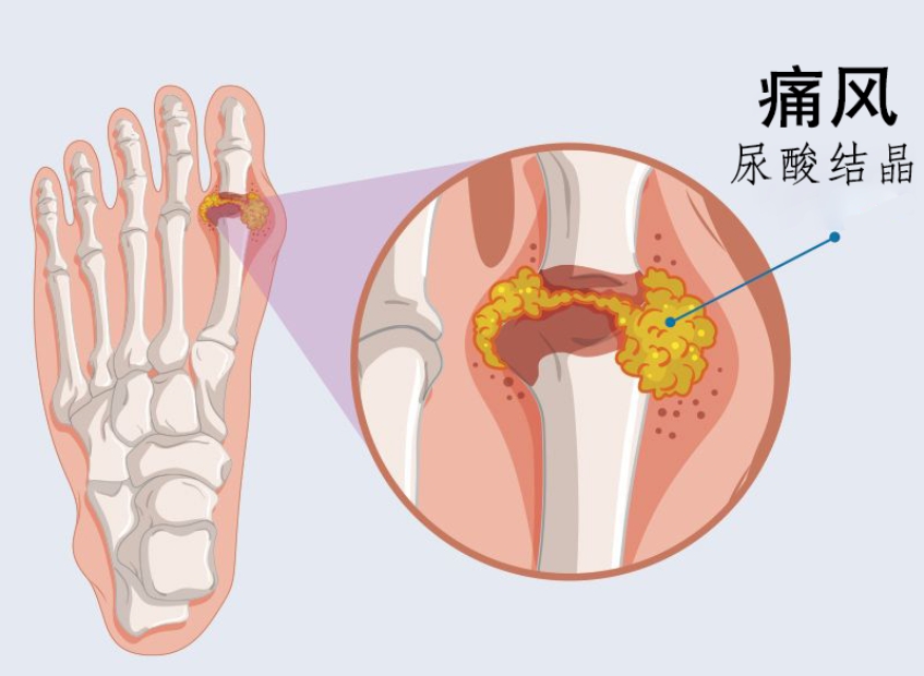 倪海厦：治痛风速度最快的经方，只有四味药