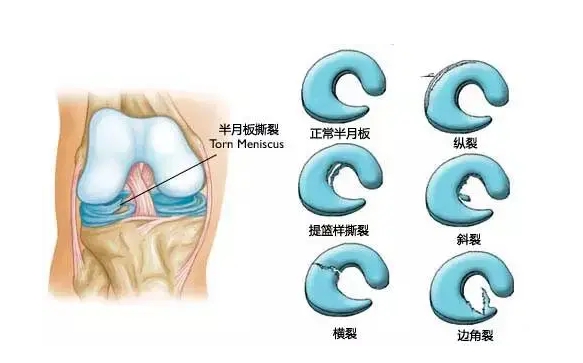 膝盖变“软”，是哪里出了问题？日常做好这些事，给膝关节减负！