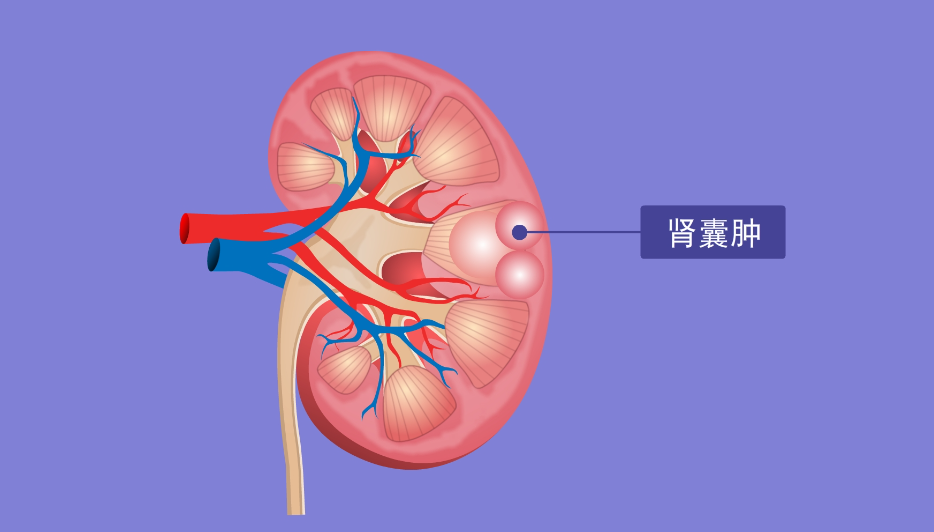 肾囊肿的4个调治方法