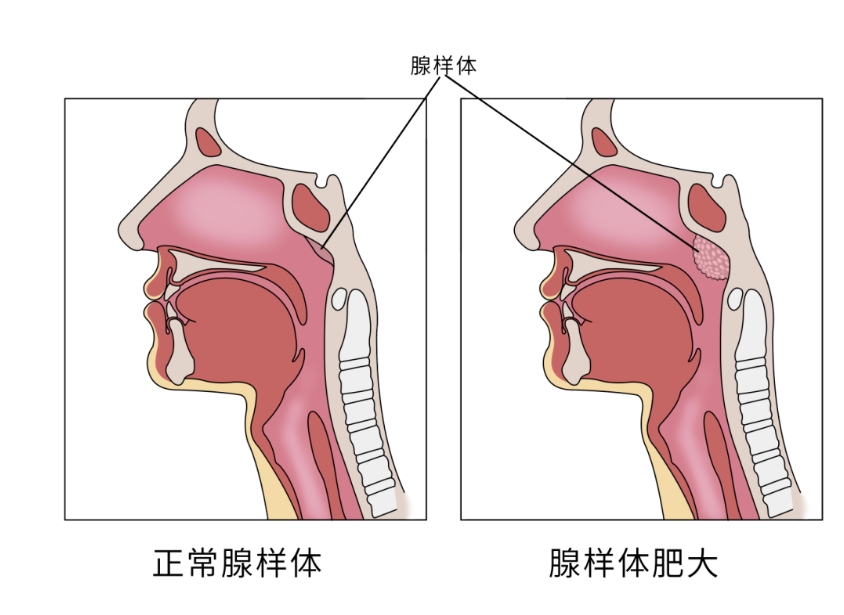 孩子腺样体肥大，到底要不要切？