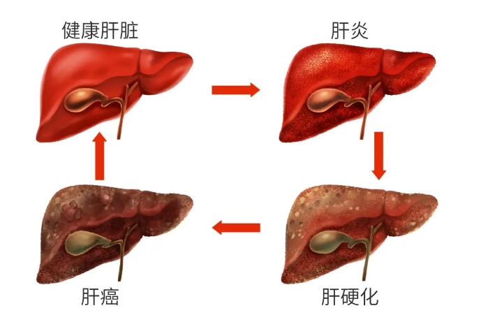 秋季肝病易复发？如何预防风险？