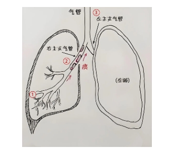 咳嗽老是好不利索？可以试试这个方法，适合各种咳嗽