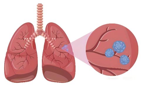 结节、息肉以及囊肿，多半是痰瘀互结！